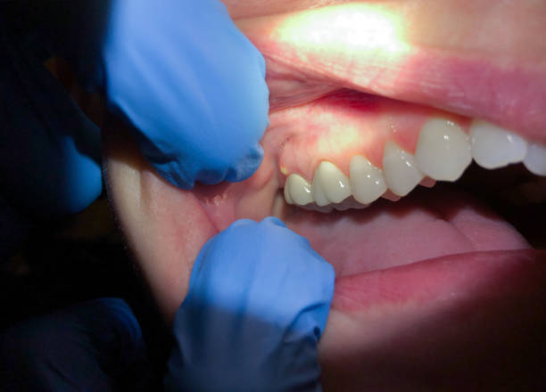Best Broken or Chipped Tooth Repair in Despard, WV